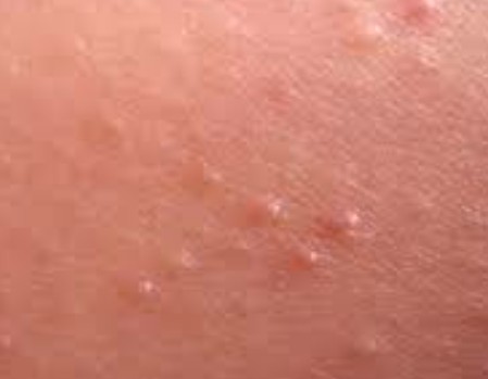 Keratosis Pilaris - Pictures, Causes, Coconut Oil Treatment