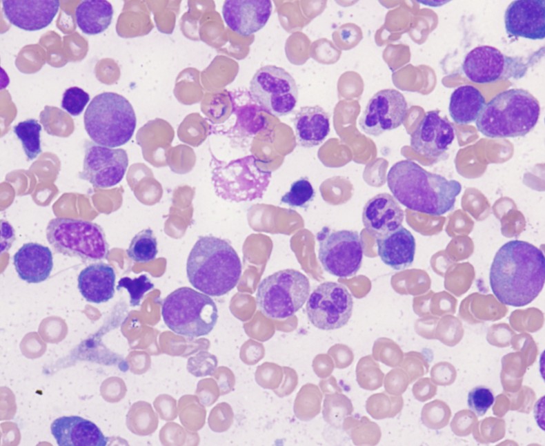 Lymphocytes Low High Causes