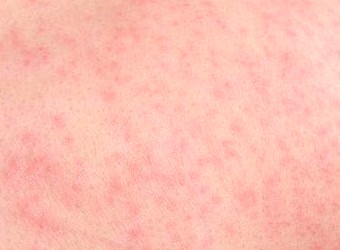 Red spots and Skin rash: Common Related Medical Conditions