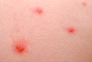 Red itchy spots - MY SKIN | HealthUnlocked