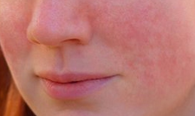 Stress Rash or Hives from Anxiety - Healthy Skin Care