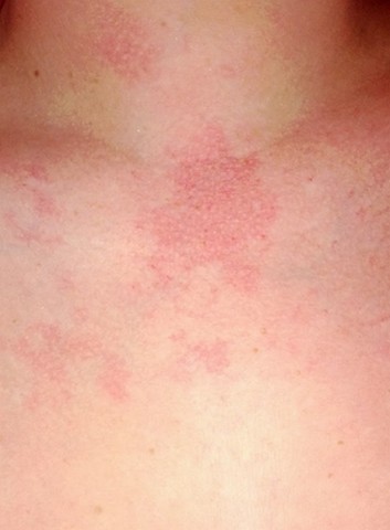 Rashes: Roseola | Parenting