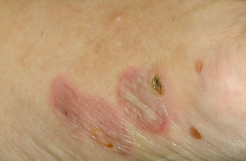 Bullous Pemphigoid - Diseases Pictures