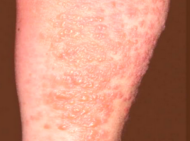 Skin Conditions and Their Relation to Autoimmune Disease ...