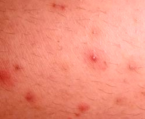 Folliculitis Causes, Symptoms, Treatment - What Are ...