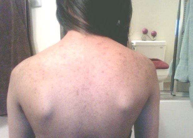 Small Red Itchy Bumps On Upper Back - HealthTap