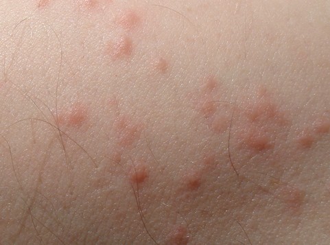 Bed Bug Bite - Pictures, Marks, Symptoms, Causes, Treatment