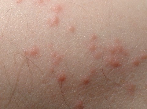 Symptoms Of Bed Bug Bites | Bed Bug Certified