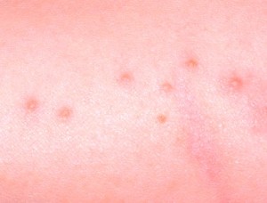 Bed bug bites treatment