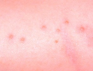 Bed Bug Bite - Pictures, Marks, Symptoms, Causes, Treatment