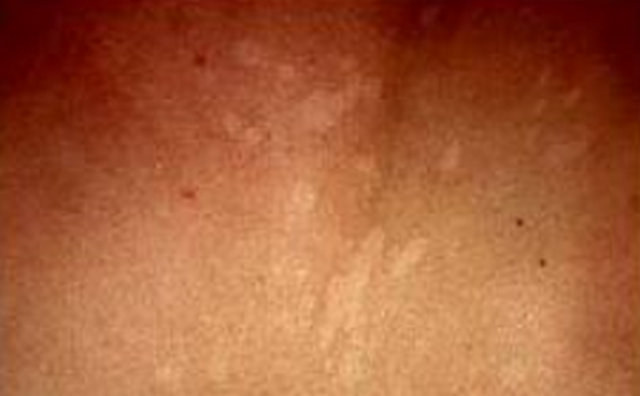 Brown Patches on Skin — The Dermatology Review