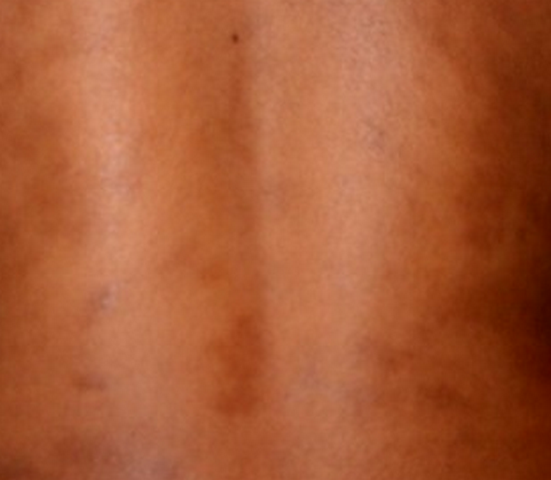 Dark Spots on Face | MD-Health.com