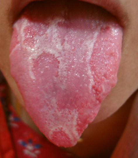 causes of geographic tongue