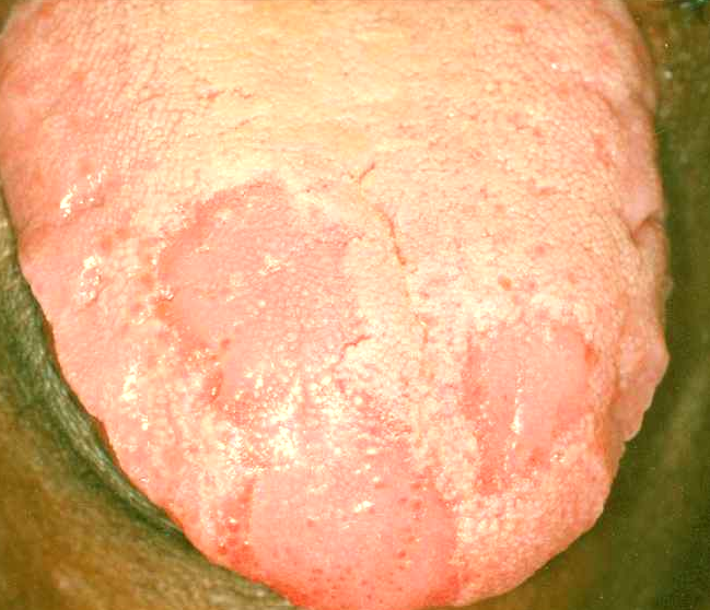 Geographic Tongue - AAOM