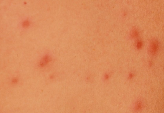 Hot Tub Rash - Pictures, Treatment, Symptoms, Causes