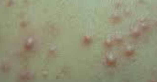 Hot Tub Folliculitis Treatment and Prevention - Verywell