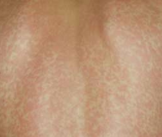 Mono Rash - Pictures, Treatment, Symptoms, Causes