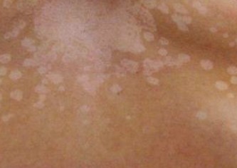 What are common causes for spots on the skin?