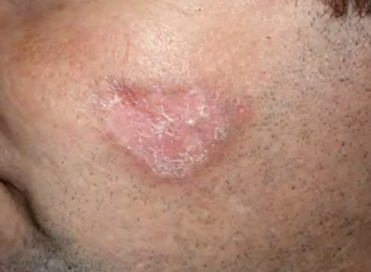 Lupus Skin Rash Pictures, Images & Photos | Photobucket