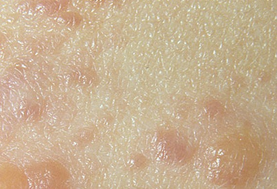 Dermatitis Herpetiformis Photos Symptoms Causes Treatment Hot Sex Picture