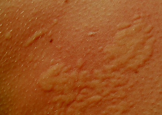 Skin Rash After Swimming Chlorine