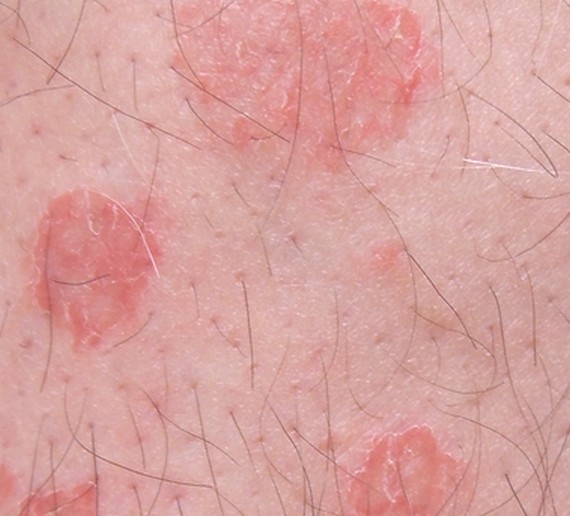 nummular eczema causes #10