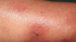 Dermatitis herpetiformis steroid treatment