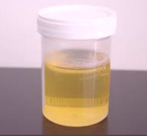 Ketones in Urine - Causes, Symptoms, Tests, Treatment