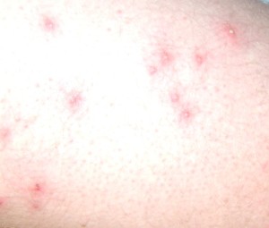 Folliculitis - Pictures, Symptoms, Causes, Treatment