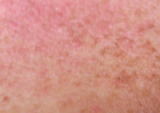 Does Mono Rash Scar