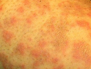 Dermatitis Herpetiformis - Photos, Symptoms, Causes, Treatment