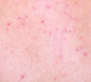 Lamictal Rash - Pictures, Symptoms, Causes, Treatment, Prevention