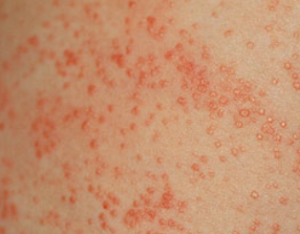 Bumpy Rash - Pictures, Treatment, Causes, Symptoms