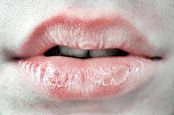 crusty-lips-treatment-causes-symptoms